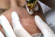 Plasma lift